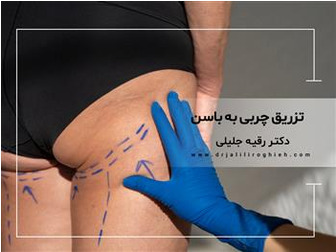 لیفت باسن برزیلی